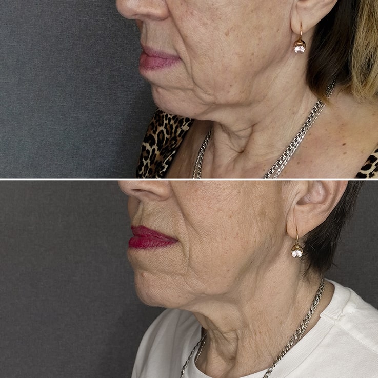 Комплексная коррекция возрастных изменений кожи лица с использованием HIFU технологий, микроигольчатого RF-лифтинга на аппарате Infini Lutronic, нитевого лифтинга средней и нижней трети лица