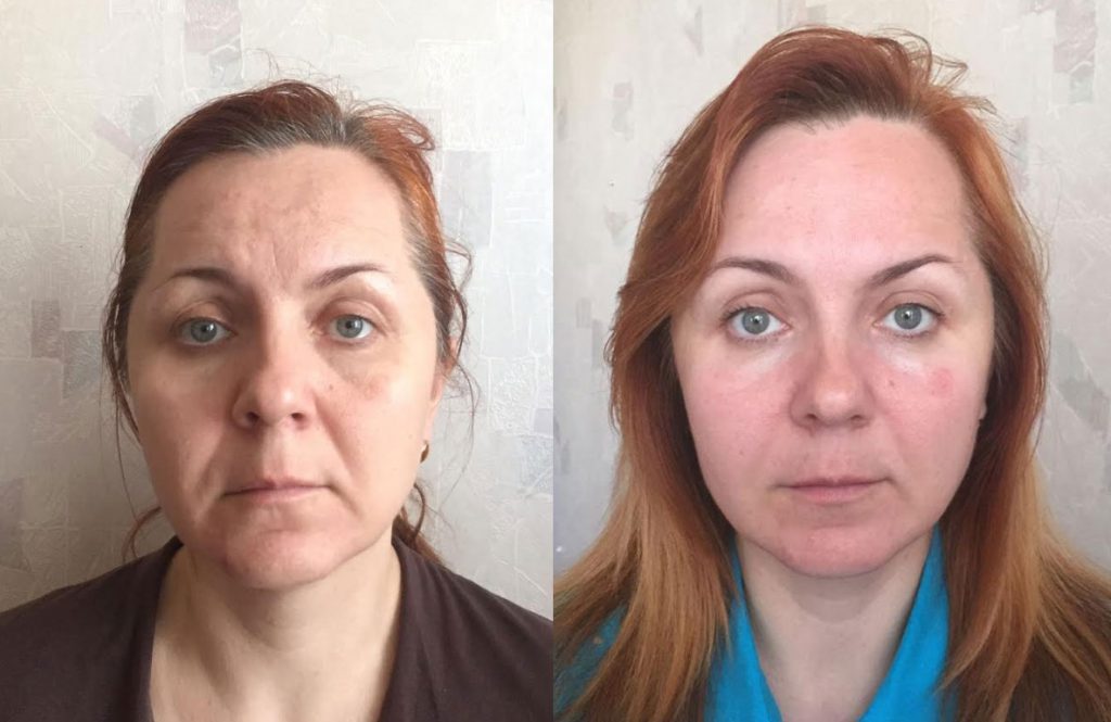 Сплит-массаж лица, фото до и после 5 сеансов