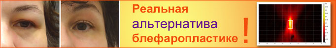 Альтернатива блефаропластике Лазерная AFT-эпиляция в центре на Таврической
