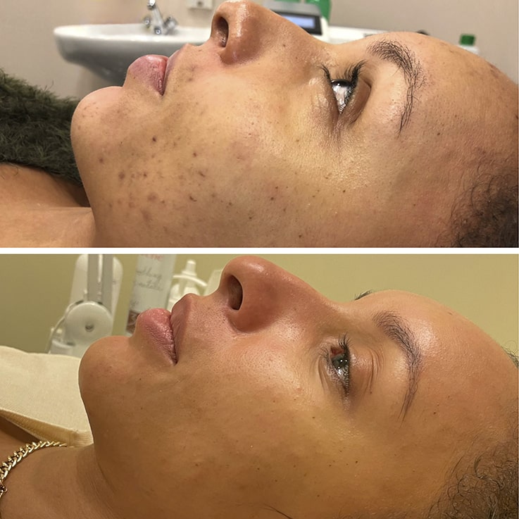 Комплексное лечение угревой сыпи с использованием комбинированной чистки кожи лица, AFT-терапии на аппарате Alma Lasers Harmony XL