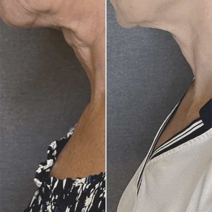 SMAS-лифтинг нижней трети лица и шеи на аппарате Microson