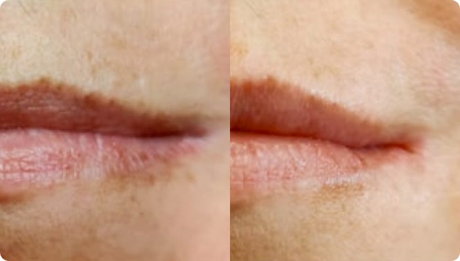 До и после, процедура Коррекция формы и контура губ