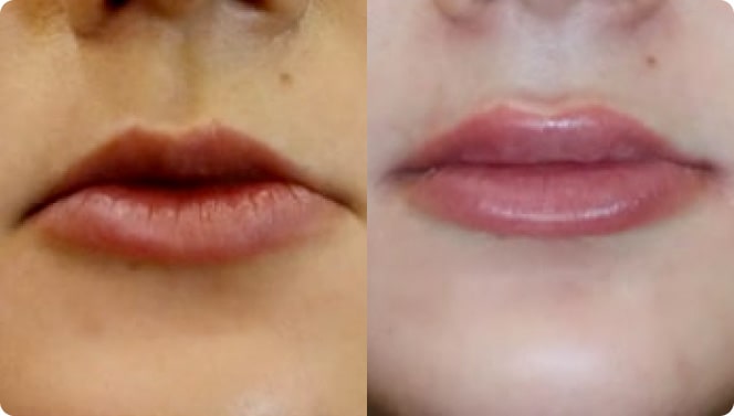 До и после, процедура Коррекция формы и контура губ
